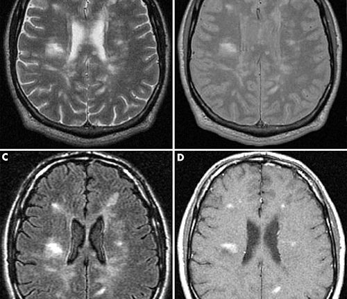 Multiple Sclerosis MRI