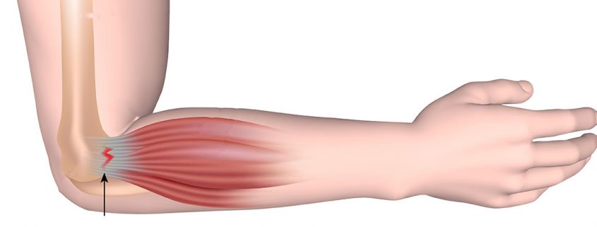 non-surgical approach in tennis elbow - درمانهای غیرجراحی در آرنج تنیس بازان