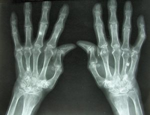 rheumatoid arthritis 06