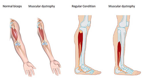 muscular dystrophy clinical symptoms - دیستروفی عضلانی علائم بالینی