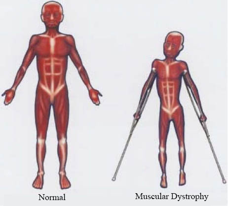 Muscular Dystrophy - دیستروفی عضلانی -03