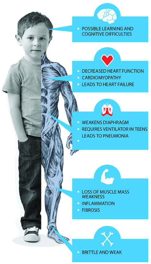 Muscular Dystrophy - دیستروفی عضلانی -04