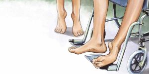 muscular dystrophy clinical symptoms - دیستروفی عضلانی علائم بالینی