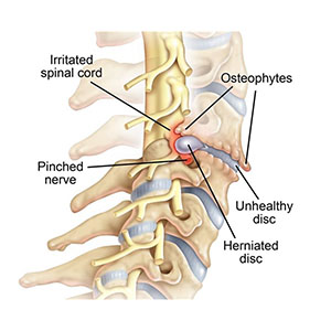 Cervical and Lumbar Disk Syndromes