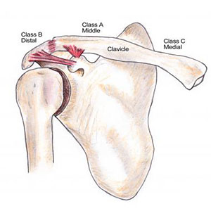 Injuries of Clavicular Complex