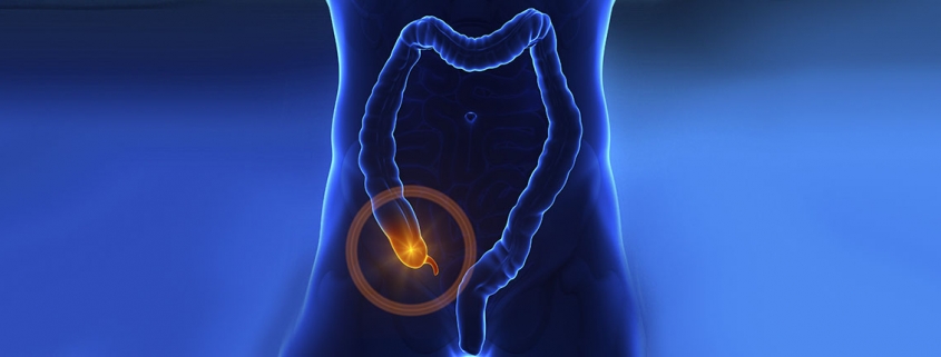Antibiotics May be Viable Option for Appendicitis Instead of Surgery - امکان درمان آپاندیست با آنتی بیوتیک وجود دارد