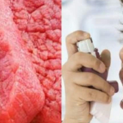 Increased Meat Consumption Associated With Symptoms of Childhood Asthma - مصرف زیاد گوشت قرمز باعث تشدید علایم آسم در کودکان میگردد
