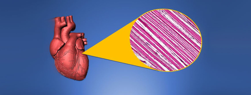 COVID-19 can kill heart muscle cells interfere with contraction - تاثیر مخرب کرونا بر قلب
