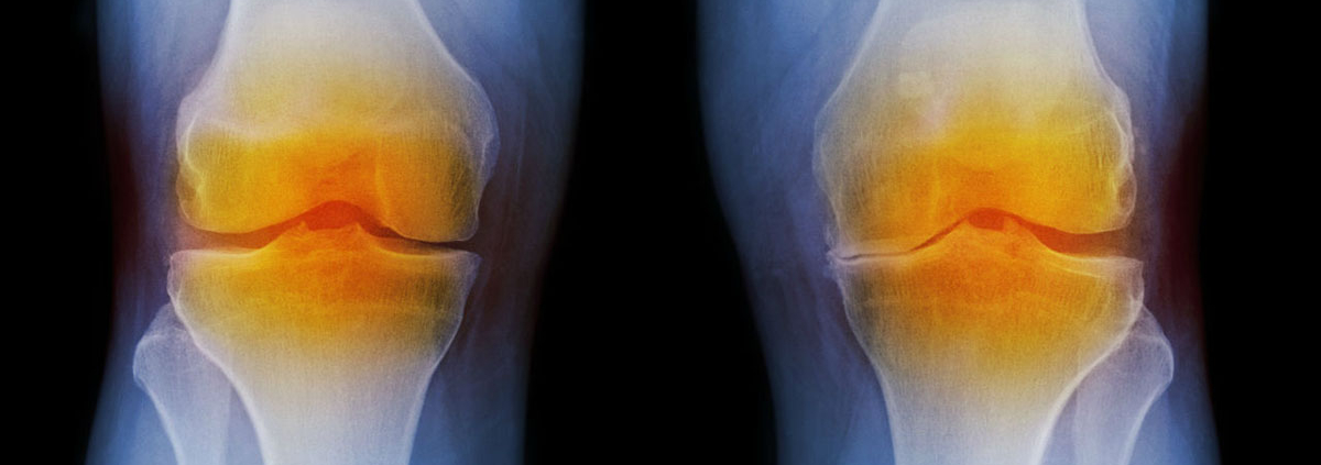 Nasal cartilage relieves osteoarthritis in the knee - درمان جدید و جالب آرتروز
