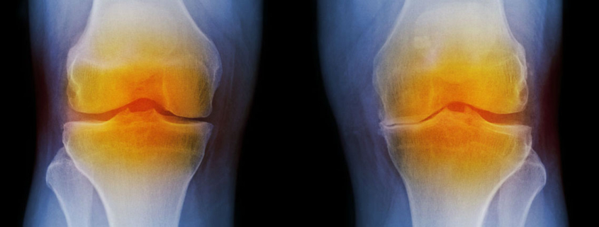 Nasal cartilage relieves osteoarthritis in the knee - درمان جدید و جالب آرتروز