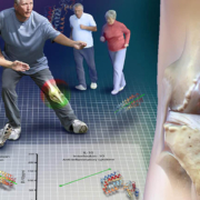 Does physical activity impact risk of knee osteoarthritis - آیا فعالیت شدید آرتروز ایجاد می کند