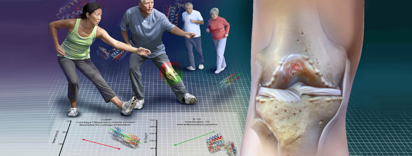 Does physical activity impact risk of knee osteoarthritis - آیا فعالیت شدید آرتروز ایجاد می کند