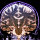 ALS therapy should target brain not just spine - اهمیت توجه به مغز در درمان ای ال اس