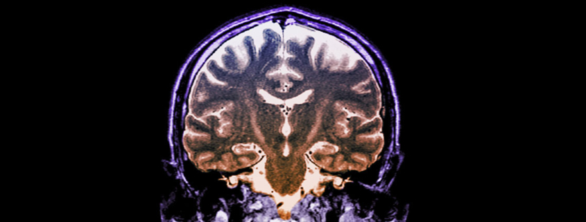 ALS therapy should target brain not just spine - اهمیت توجه به مغز در درمان ای ال اس